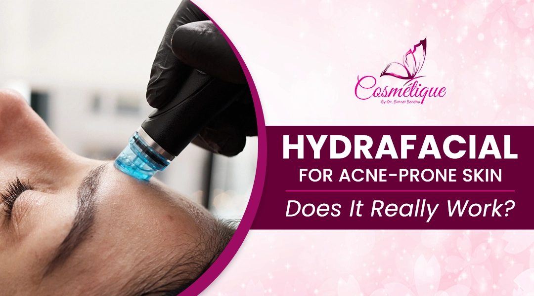 HydraFacial for Acne-Prone Skin: Does It Really Work?